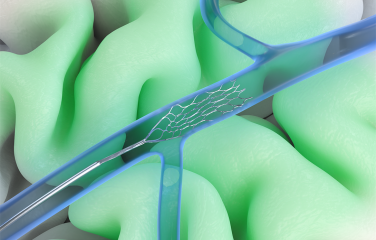 An artist's impression of Synchron's Stentrode device implanted in a brain.